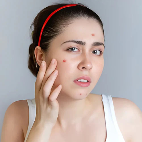 Acnes