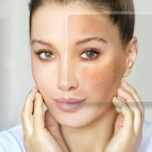 Melasma Care